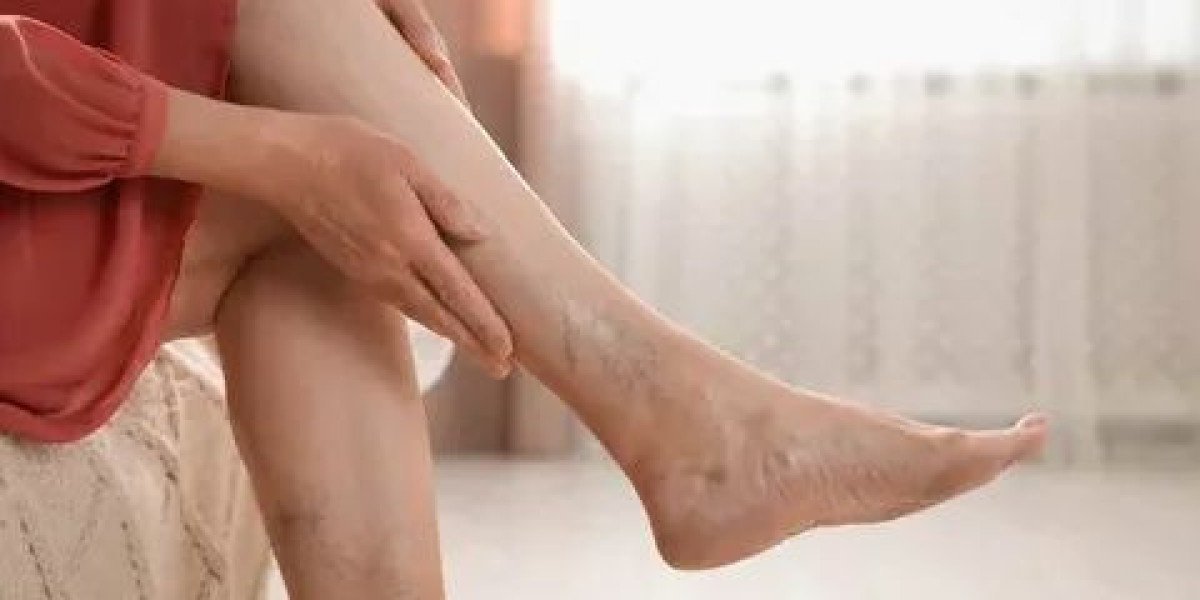 How to Revitalize Legs Affected by Vein Issues
