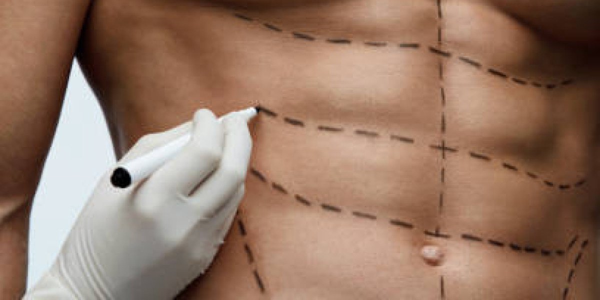 Liposuction for Achieving a Sharper Body Profile